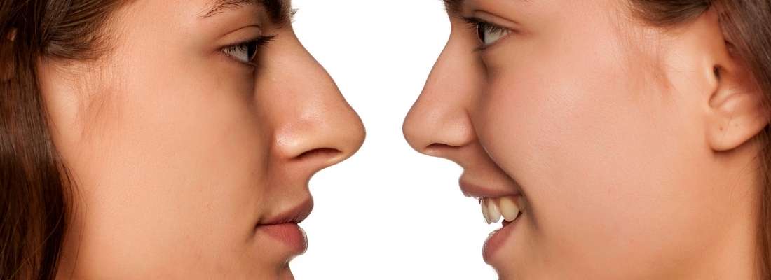 Rhinoplastie médicale avant après jeune femme de 27 ans